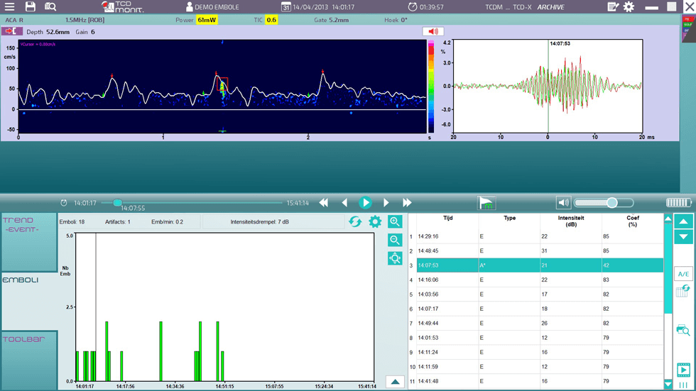 Emboli Detection Software