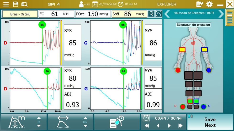 Angiolys 4 PPG signalen simultan