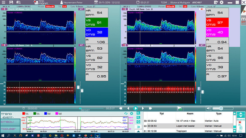 TCD Doppler Bi-Lateral Monitoring