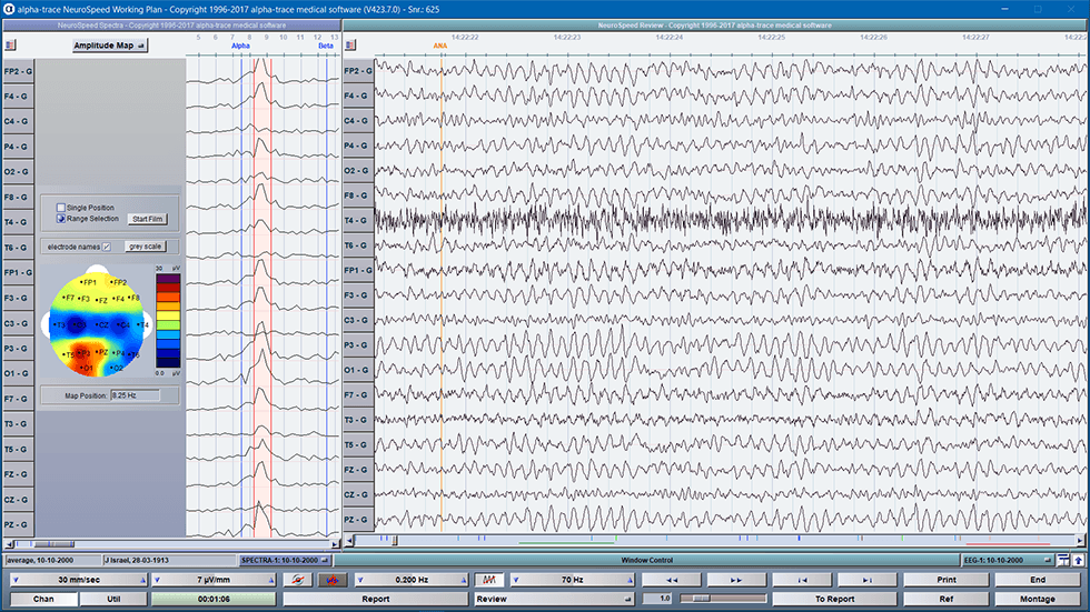 EEG mit Frequenz Map im Alpha-Band