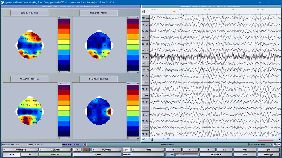 EEG mit Power Map: Delta, Theta, Alpha, Beta