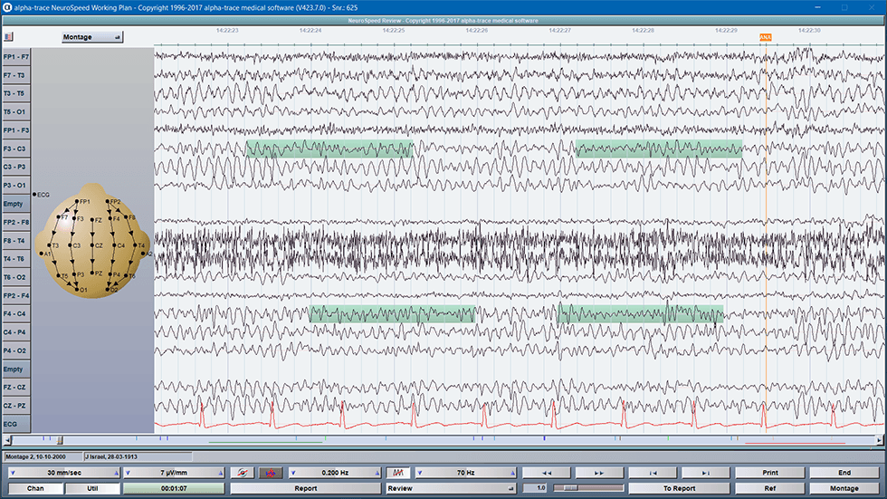 EEG mit  Analyse Abschnitte