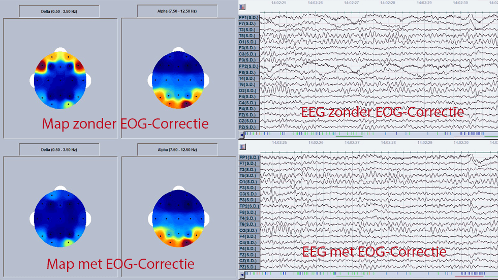EEG Delta-Band ohne und mit Augen-Korrektur 