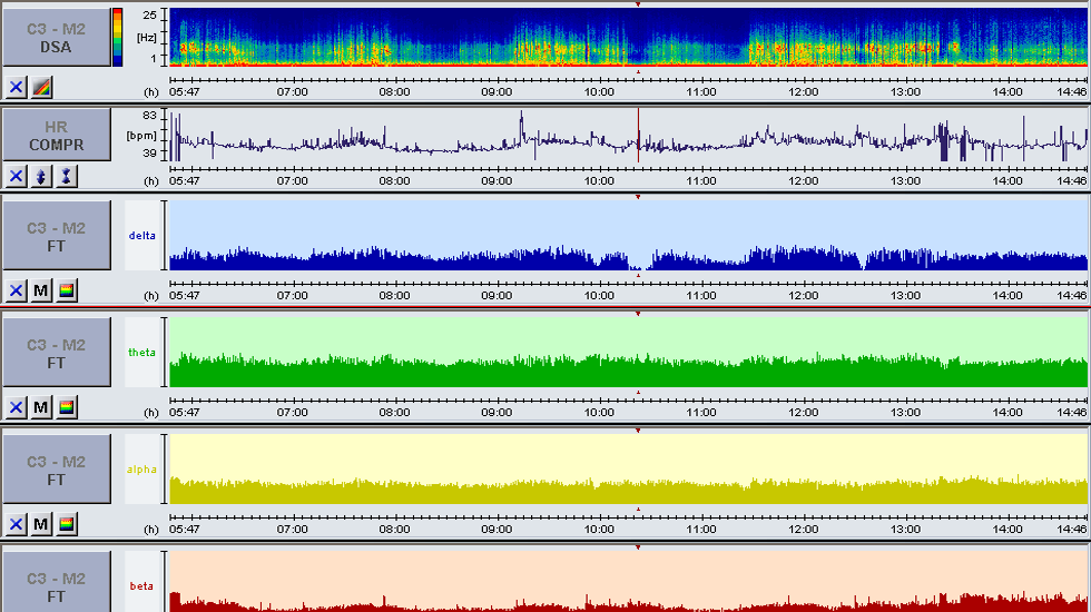 Analysiertes EEG Signal während Registrierung