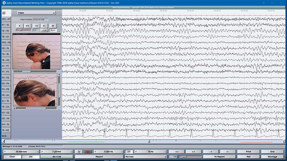 Video EEG