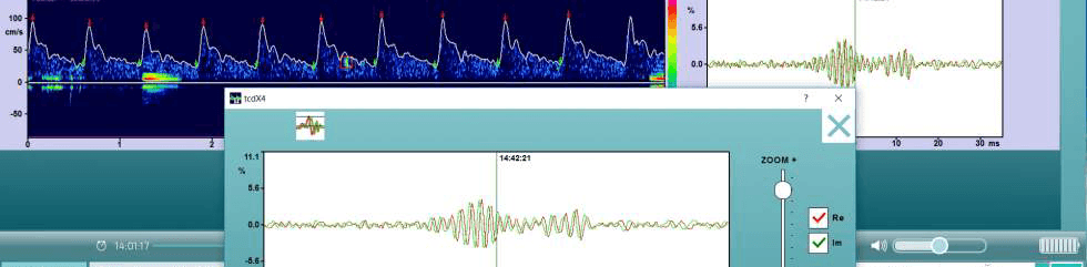 Embolie Detection Software